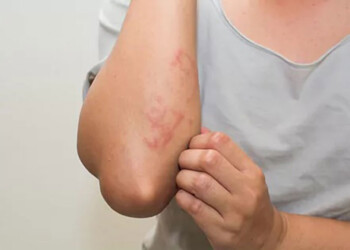 Dermatitis atópica: una afección cutánea crónica que no se contagia y que puede controlarse con el tratamiento adecuado