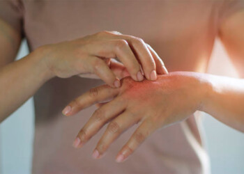 Psoriasis: alertan sobre curas milagrosas y las barreras económicas para tratarse